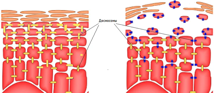 Seasonal Shedding or Disease? Exfoliative Keratolysis - My, The medicine, Disease, Disease history, Body check, Longpost, Doctors, Problem skin, Leather, Dermatology, Kvd, Treatment, Genetic diseases