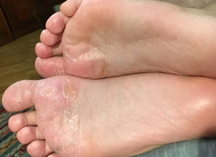 Seasonal Shedding or Disease? Exfoliative Keratolysis - My, The medicine, Disease, Disease history, Body check, Longpost, Doctors, Problem skin, Leather, Dermatology, Kvd, Treatment, Genetic diseases