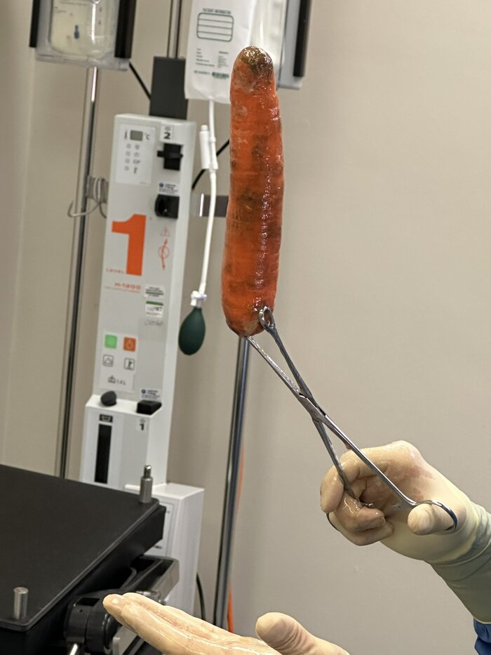 Мужчина, 29 лет, полез в погреб, подскользнулся на лестнице и упал прямо на мешок с морковкой, результат на фото, мужчины будьте осторожнее