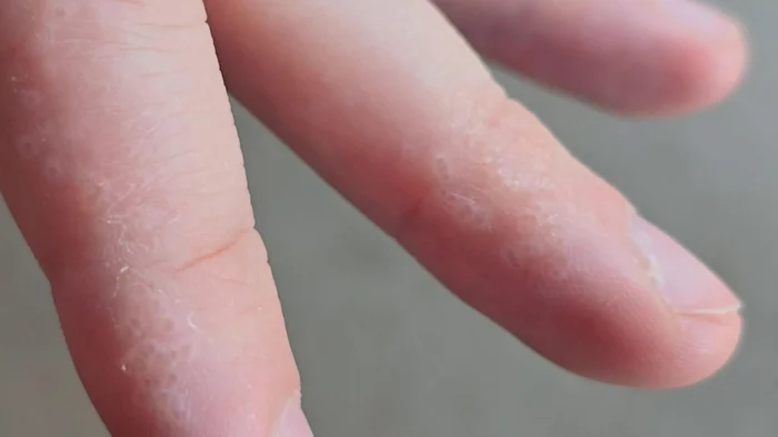 Seasonal Shedding or Disease? Exfoliative Keratolysis - My, The medicine, Disease, Disease history, Body check, Longpost, Doctors, Problem skin, Leather, Dermatology, Kvd, Treatment, Genetic diseases