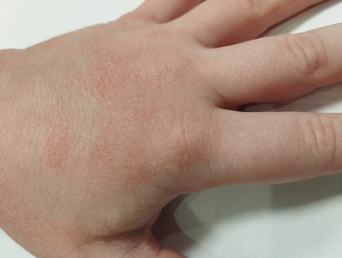 Рука с покраснением и шелушением