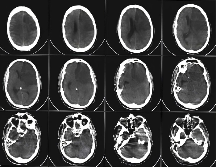 Искусственный интеллект выявил два новых гена риска ишемического инсульта