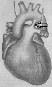 Стрелочка указывает на артериальный проток
