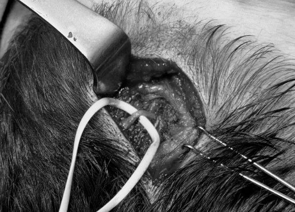 Доступ к затылочному нерву. Он выделен и подтянут резинкой.