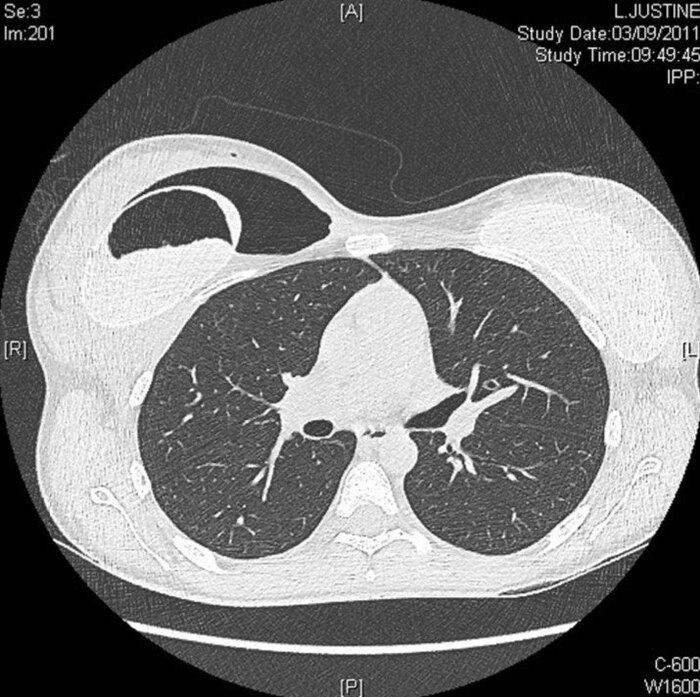 Figure 3. Предоперационная компьютерная томография грудной клетки: отмечается наличие воздуха и жидкости в перипротезной ложбинке, а также в самом импланте.