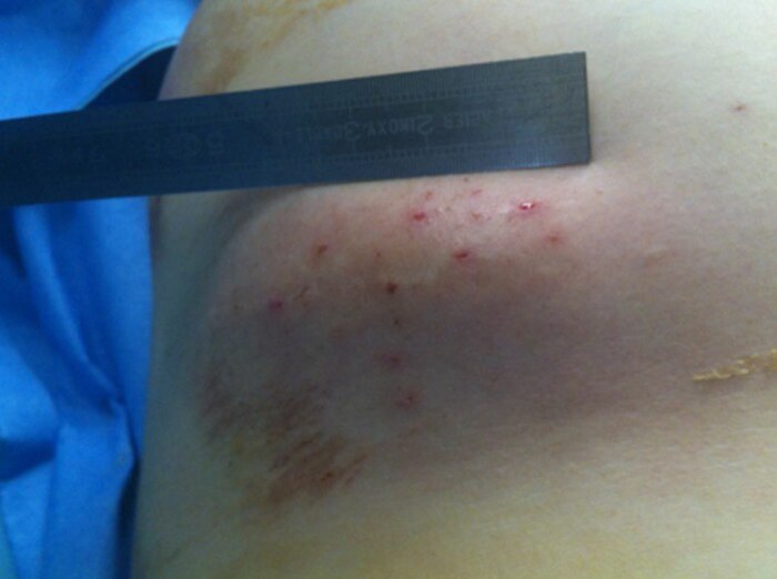 Figure 2. Фотография точечных поражений после самостоятельных инъекций физ. р-р рядом с правой молочной железой.