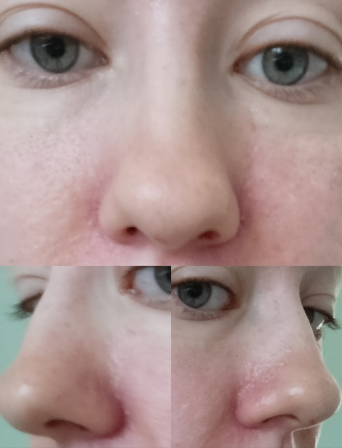 День выписки. Неделя после операции .