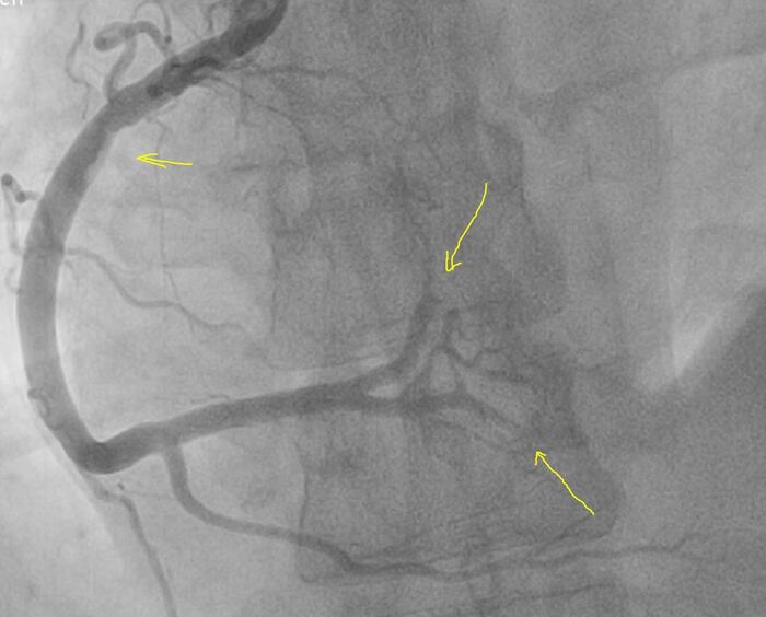 Стрелками места КУДА "улетели" тромбы, верхняя стрелка ОТКУДА они "улетели"