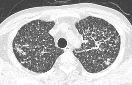 Многочисленные хаотично расположенные разнокалиберные очаги в легких на КТ