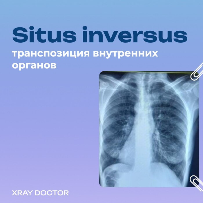 Situs inversus    .     