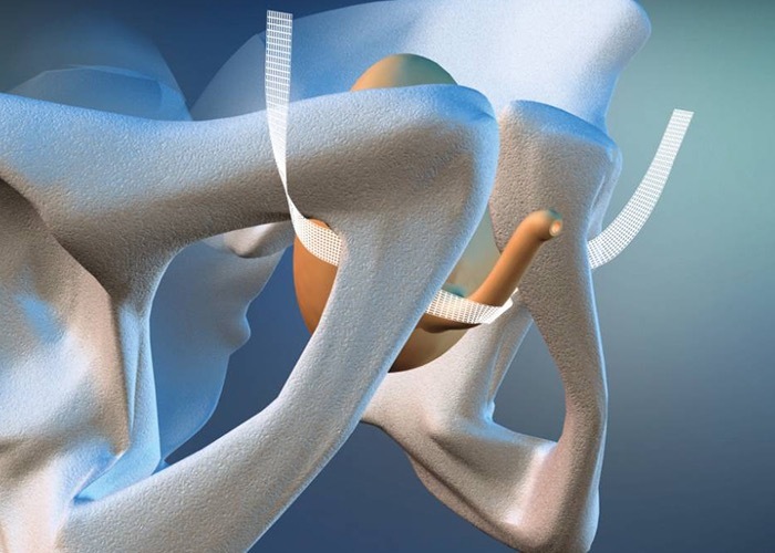 Схематичное изображение расположение синтетического импланта.