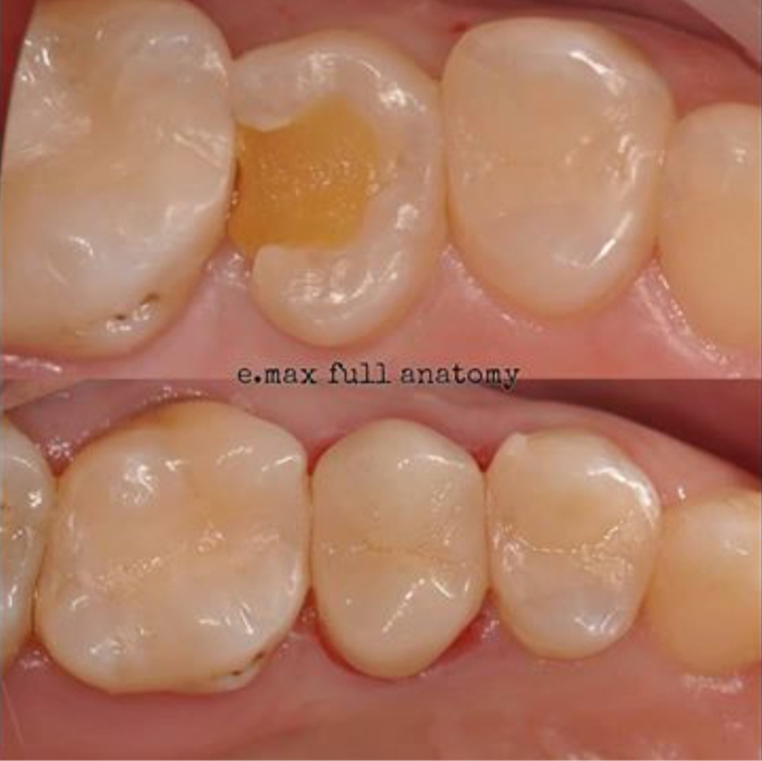 -.   inlay e.max (   ,      ).