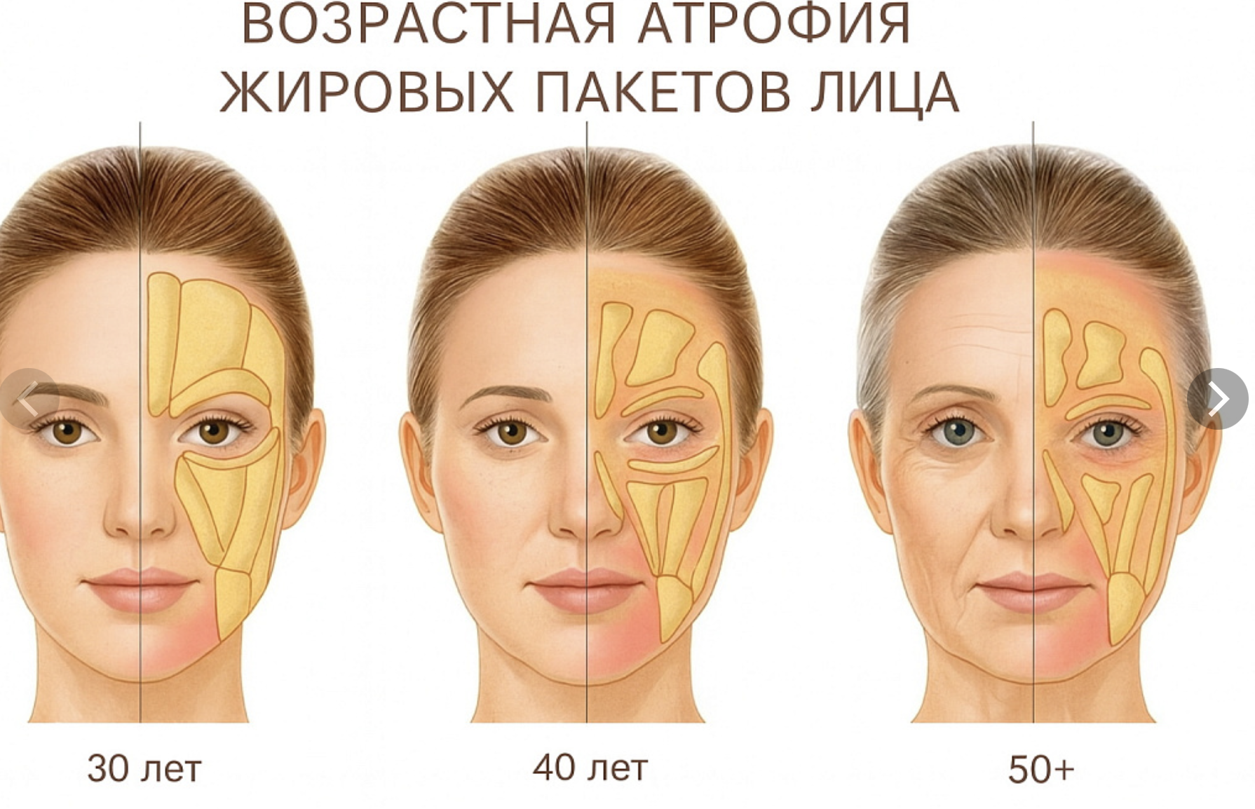 How to restore your original face without signs of overtightening? - My, Face, Facelift, Blepharoplasty, Video, Vertical video, Short videos, Longpost