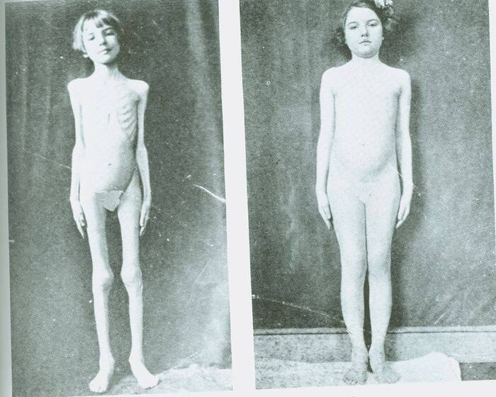 Ребёнок с диабетом до и через несколько месяцев получения инсулина