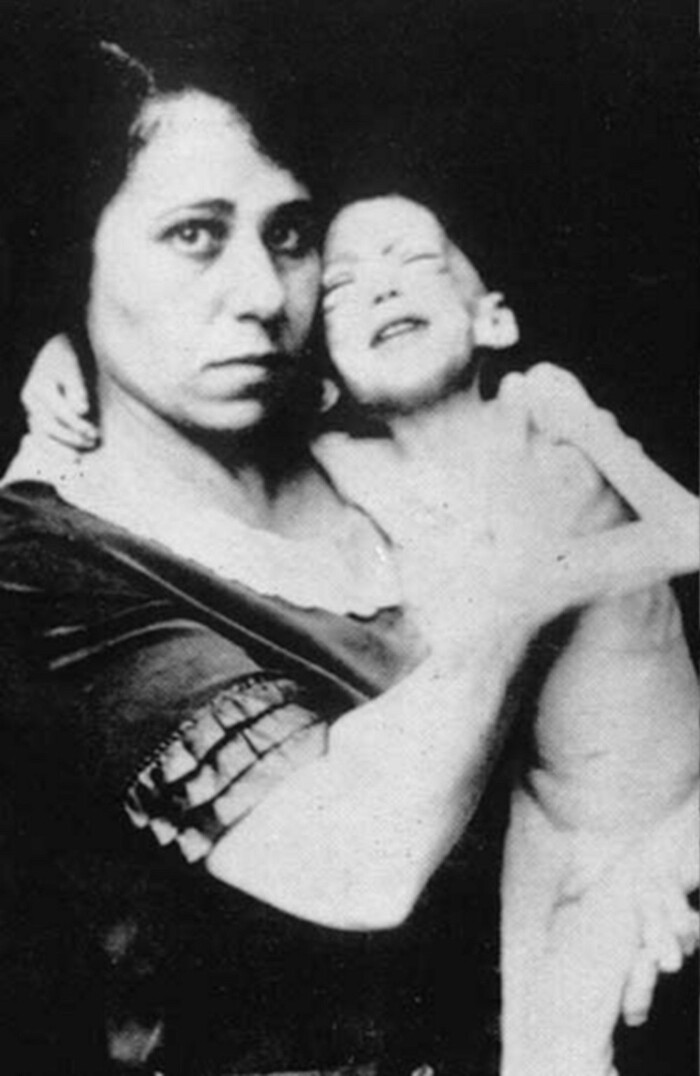 Как выглядели дети с диабетом. Обычно после постановки диагноза им оставалось жить несколько месяцев