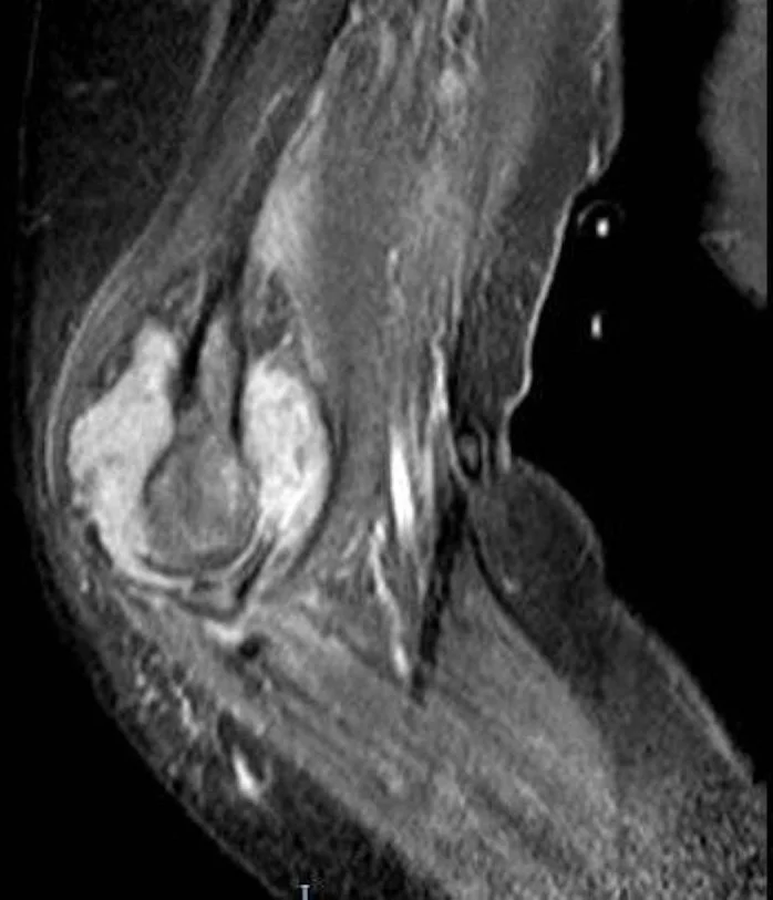 Elbow Pain. Part II. Inflammatory Diseases - My, Health, The medicine, Rheumatology, Rheumatologist, Rheumatoid arthritis, Bechterew's disease, Ankylosing spondylitis, Psoriatic arthritis, Gout, Infection, Disease, Longpost