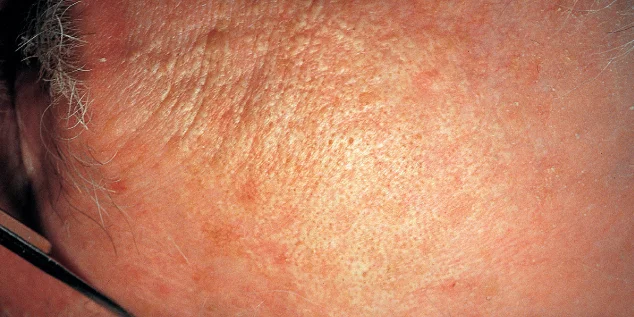 Take care of your skin from a young age - My, Nauchpop, The sun, Tan, Leather, Disease, Dermatology, Health, Mutation, Longpost