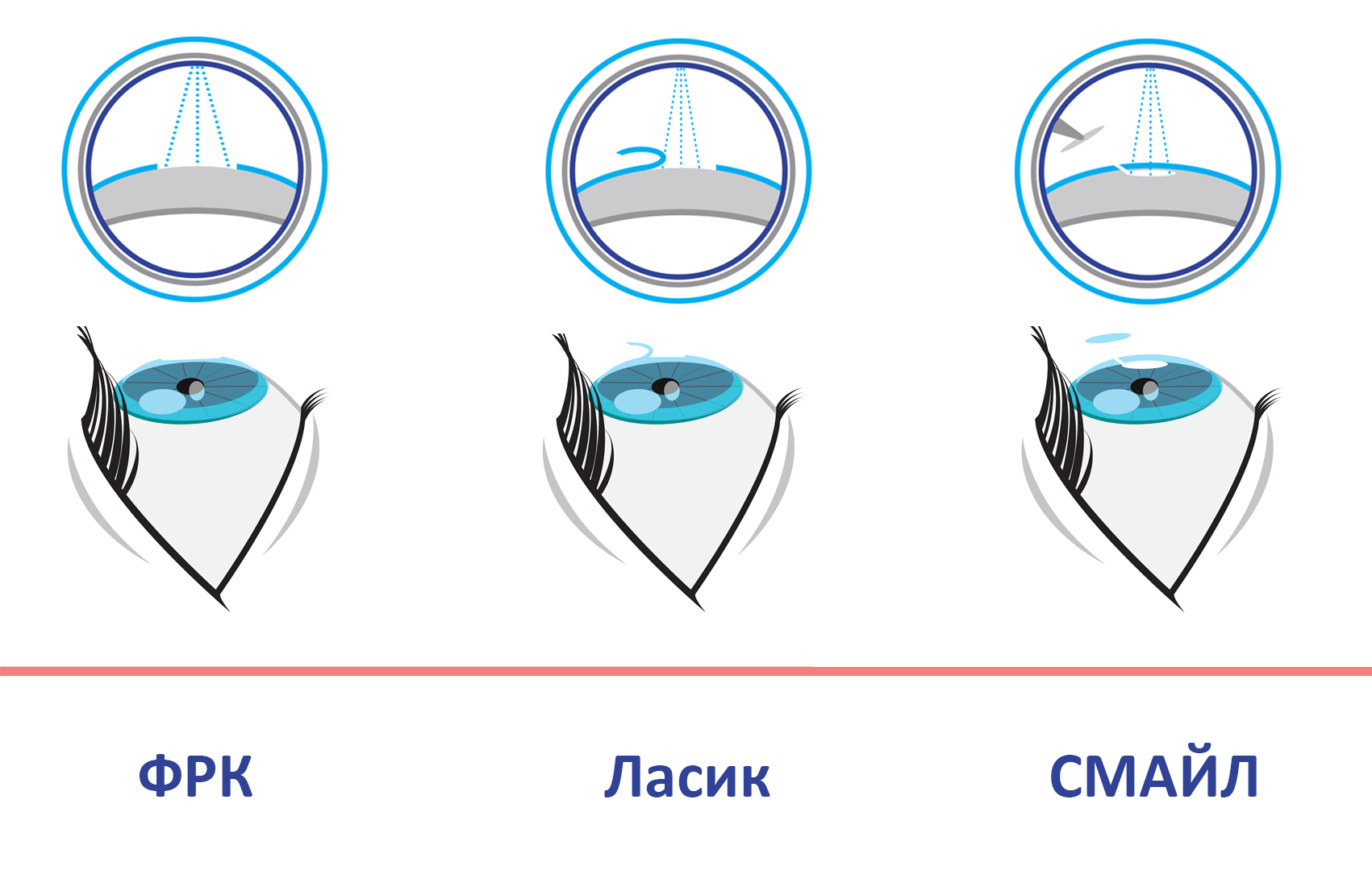 Re-correction of vision using PRK after LASIK - My, LASIK, Laser correction, Frk, Operation, Longpost