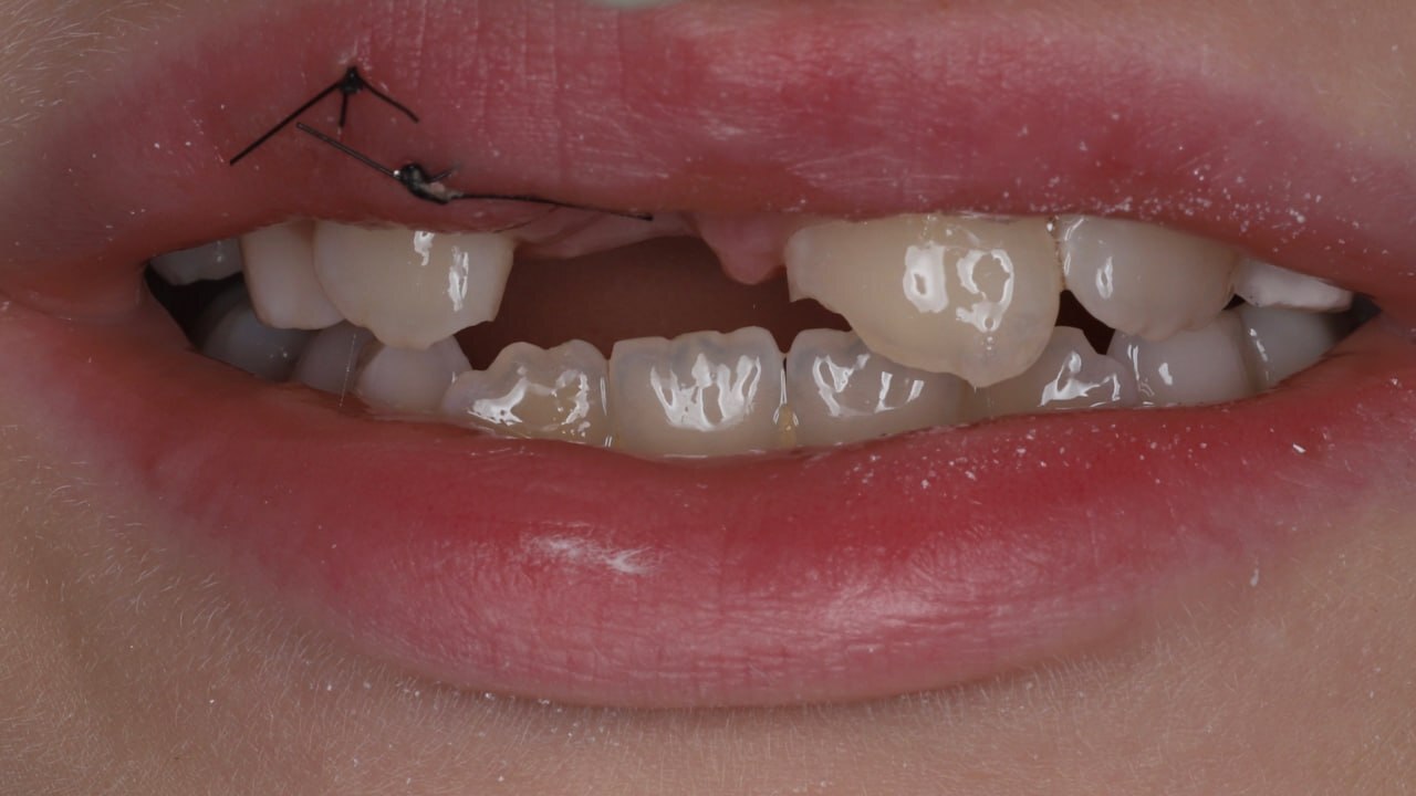 An 8-year-old female patient was referred by a colleague from St. Petersburg. - Dentistry, Teeth, Doctors, Health