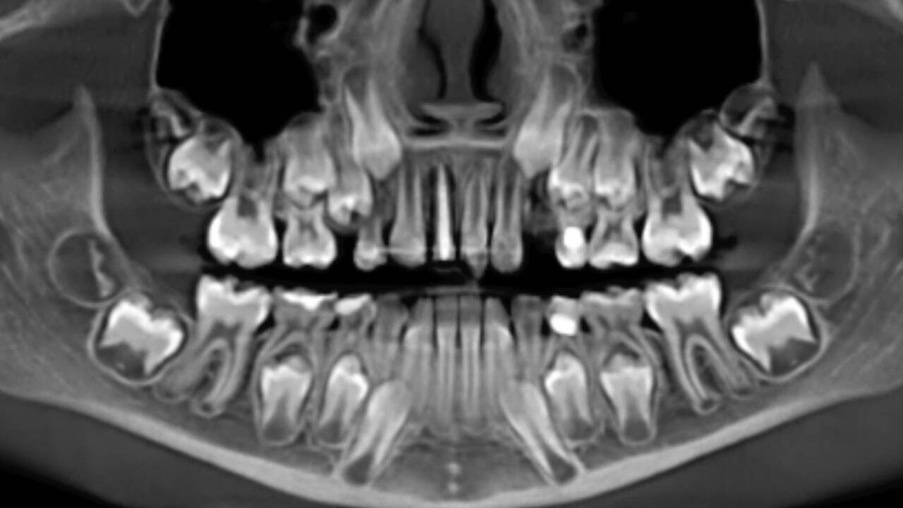 An 8-year-old female patient was referred by a colleague from St. Petersburg. - Dentistry, Teeth, Doctors, Health