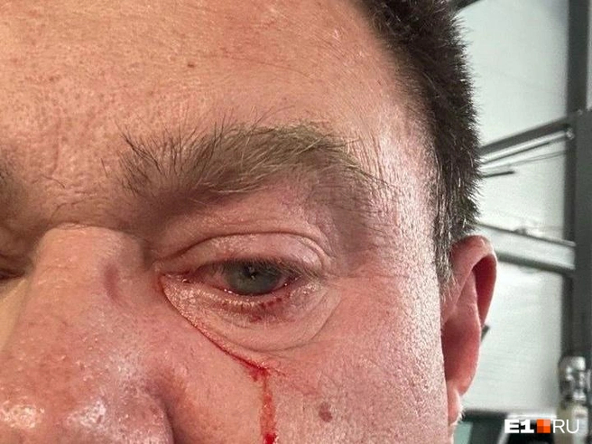 Юрий написал заявление в полицию Источник: читатель <!--noindex--><a href="https://pikabu.ru/story/babki_na_kapot_ska_v_ekaterinburge_rabotnik_avtoservisa_edva_ne_lishilsya_zreniya_izza_nedovolnogo_klienta_14460437?u=http%3A%2F%2FE1.RU&t=E1.RU&h=d14cb2f4849bc246a517d6332b909846dc263a36" title="http://E1.RU" target="_blank" rel="nofollow noopener">E1.RU</a><!--/noindex-->